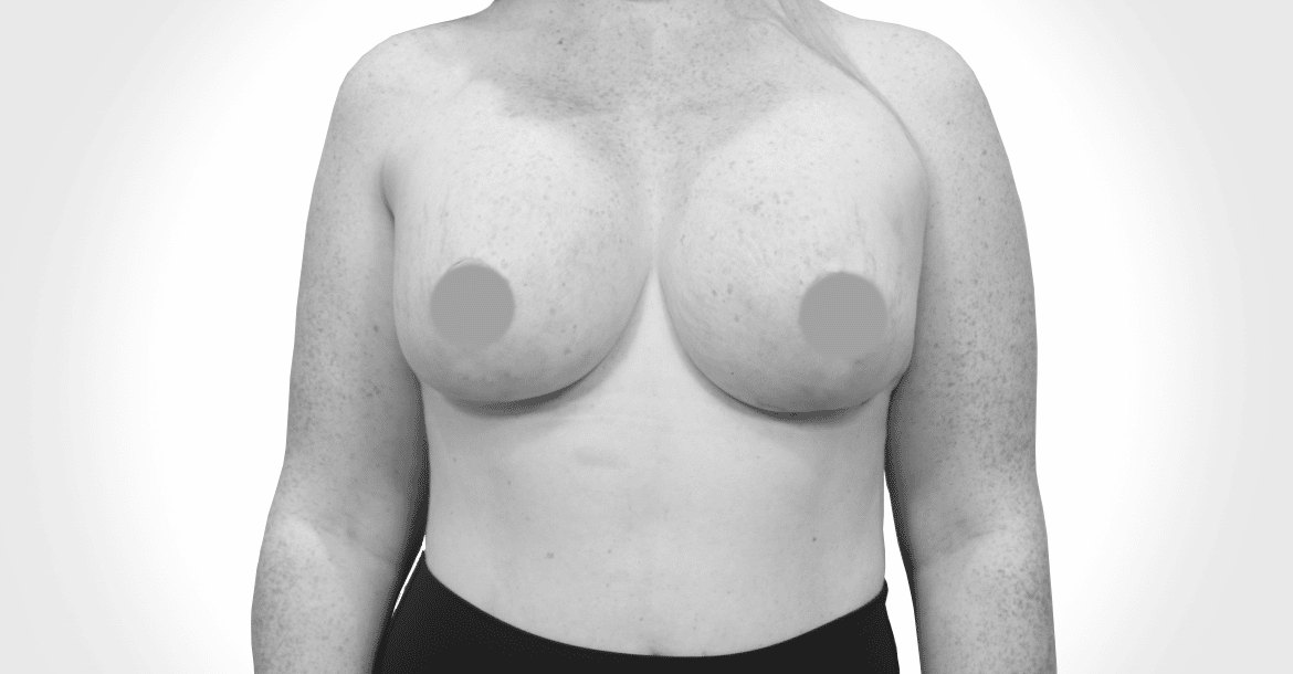 After-BREAST LIFT