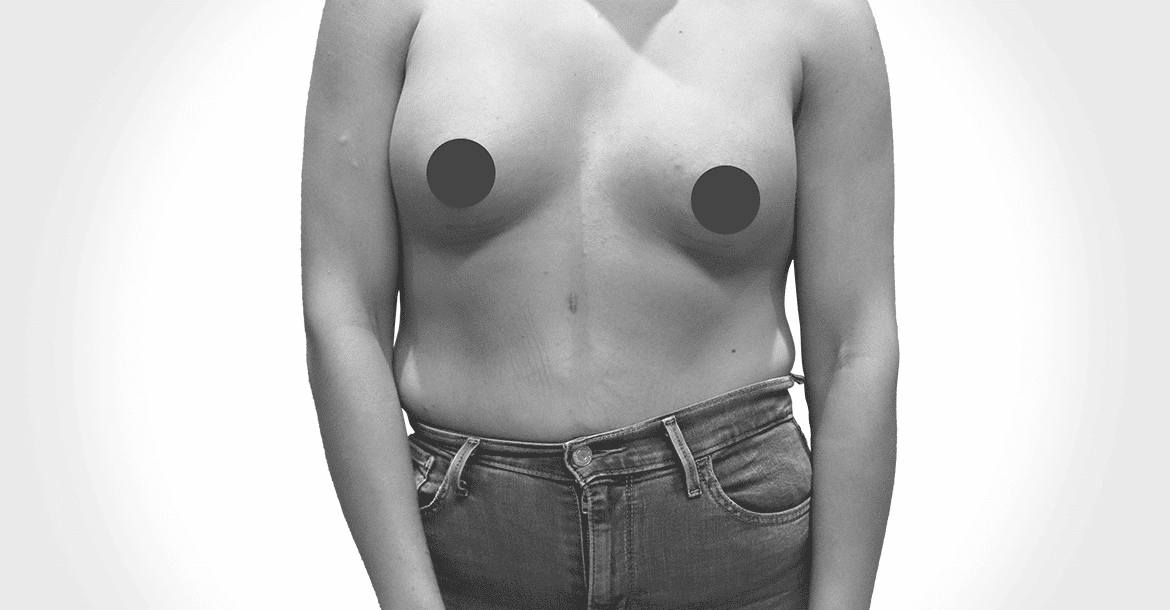 After-TUBEROUS BREAST HISTORY