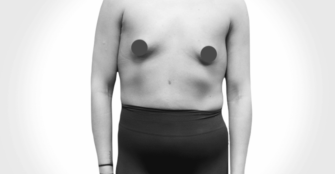 Before-TUBEROUS BREAST HISTORY