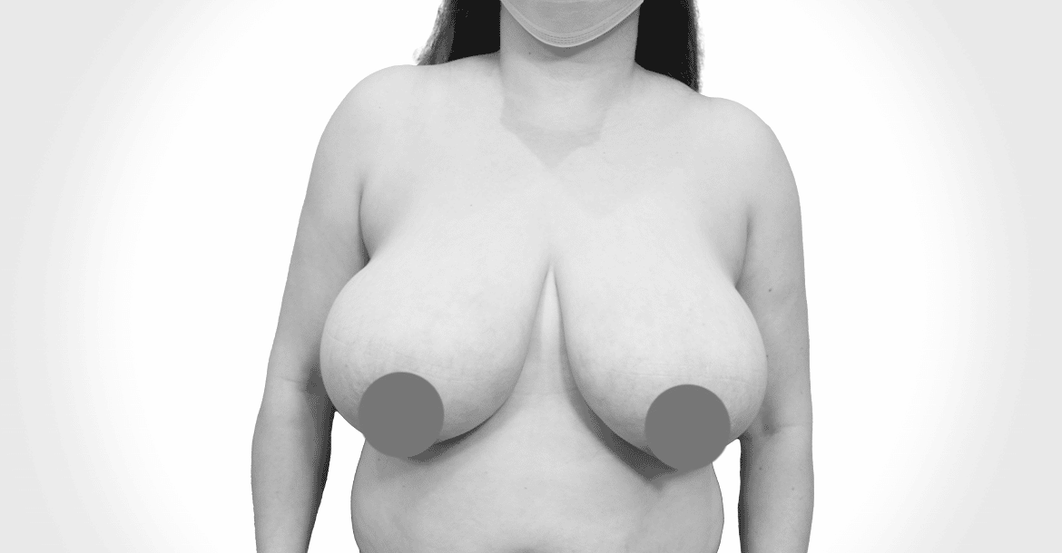 Before-BREAST AUGMETATION AND LIFT