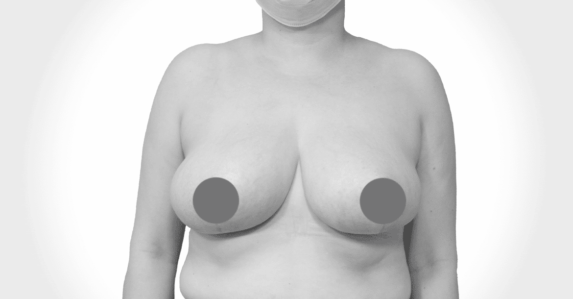After-BREAST AUGMETATION AND LIFT