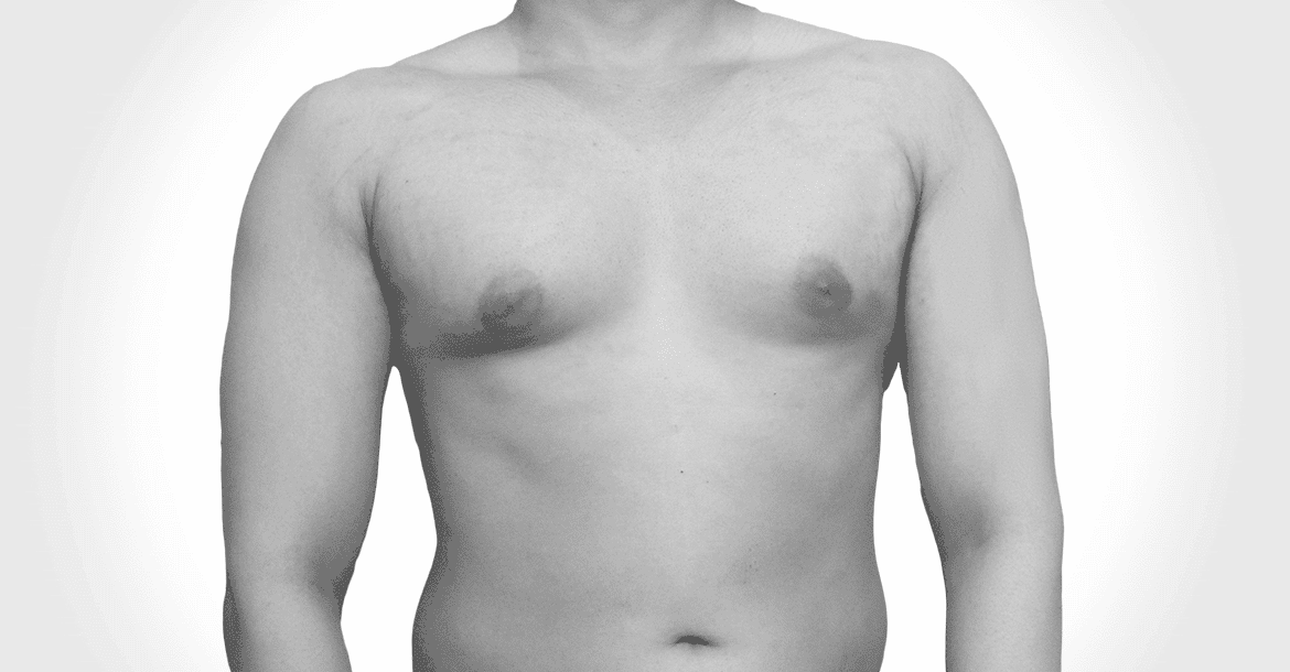 Before-MALE BREAST REDUCTION