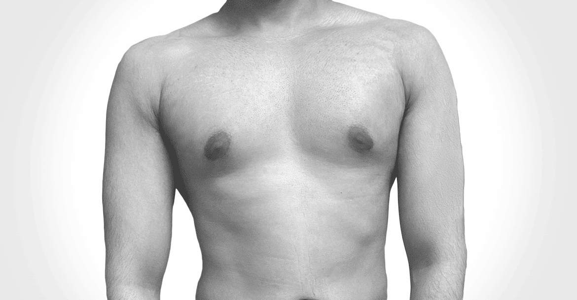 After-MALE BREAST REDUCTION