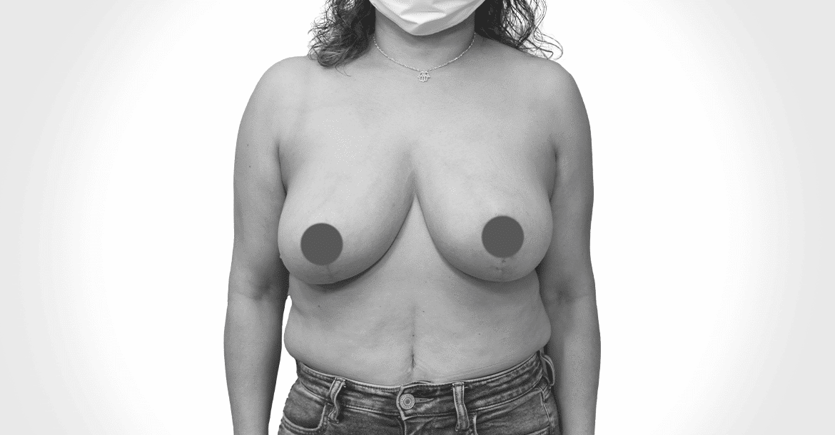 After-BREAST AUG + LIFT