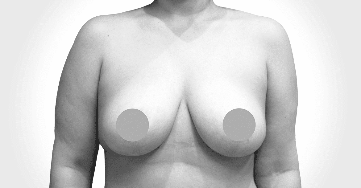 After-MASTOPEXY