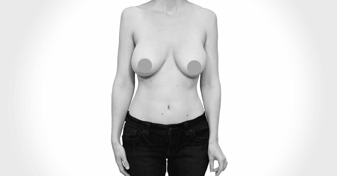 Before- BREAST LIFT + IMPLANT