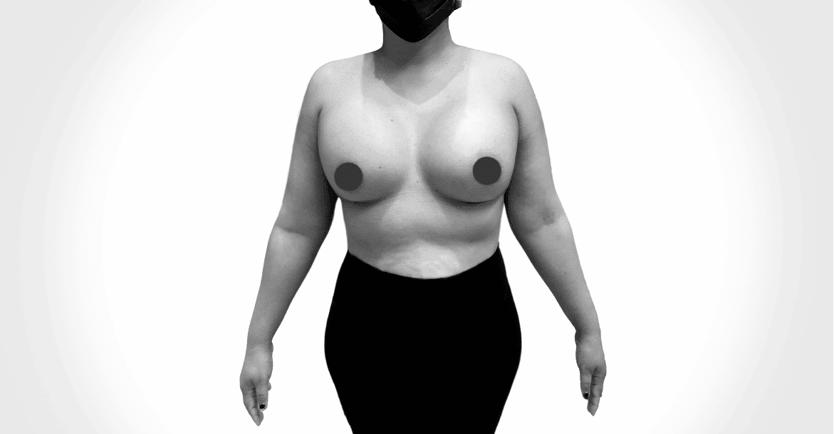 After-BREAST AUGMETATION