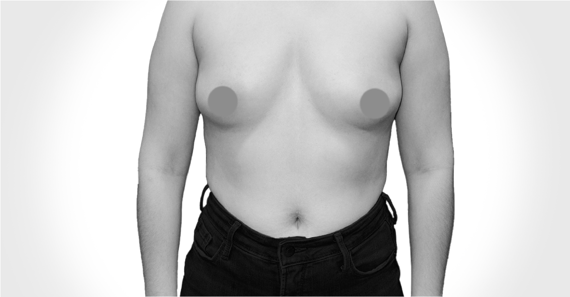 Before-BREAST AUGMENTATION