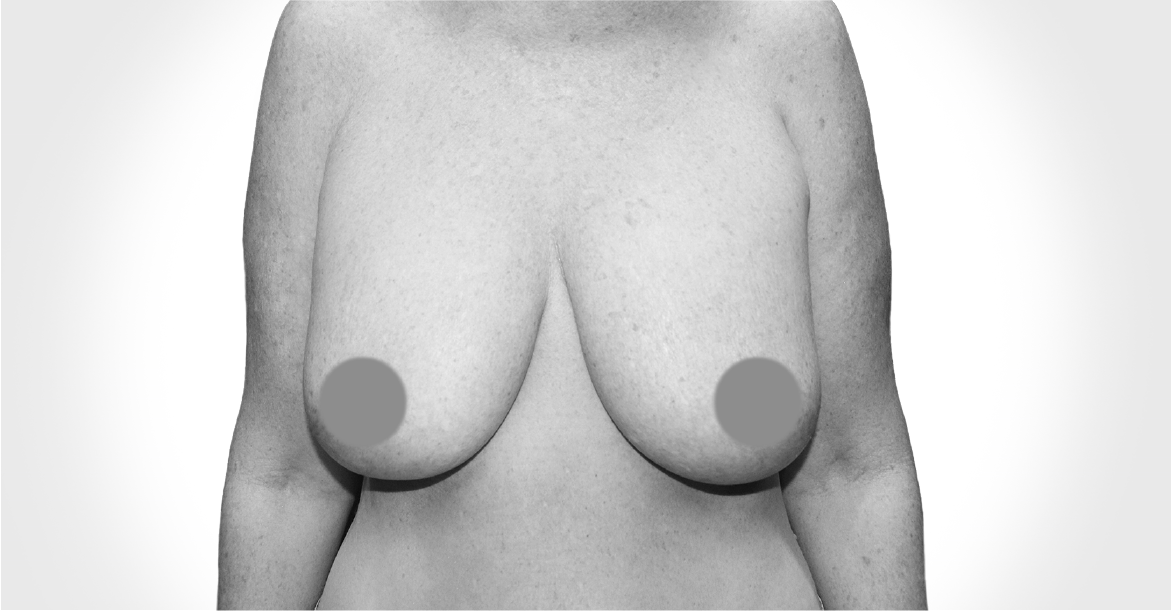 Before-BREAST LIFT