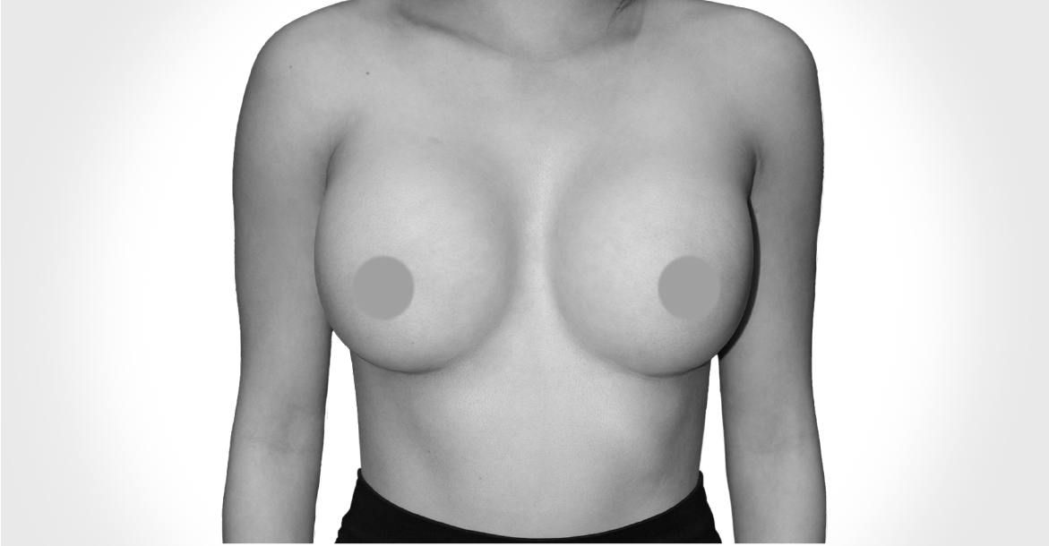 After-BREAST AUGMENTATION