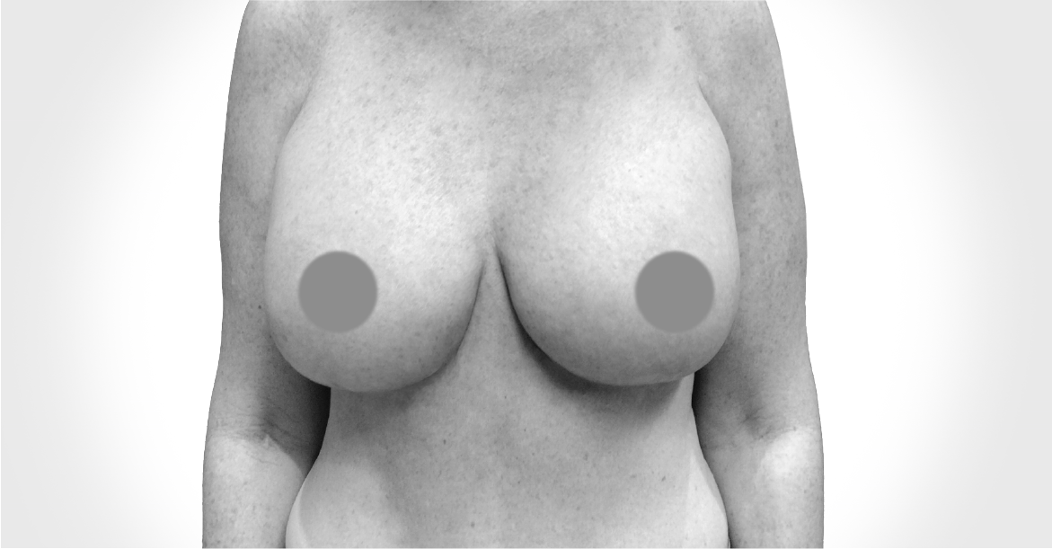 After-BREAST LIFT