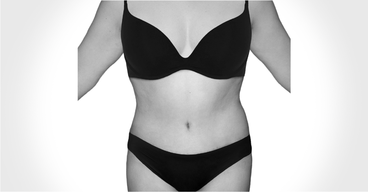 After-TUMMY TUCK